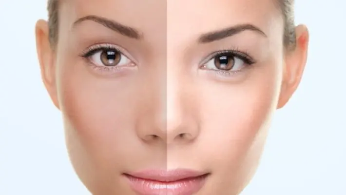 Laser Treatment for Brighter Skin: What You Need to Know in 2025